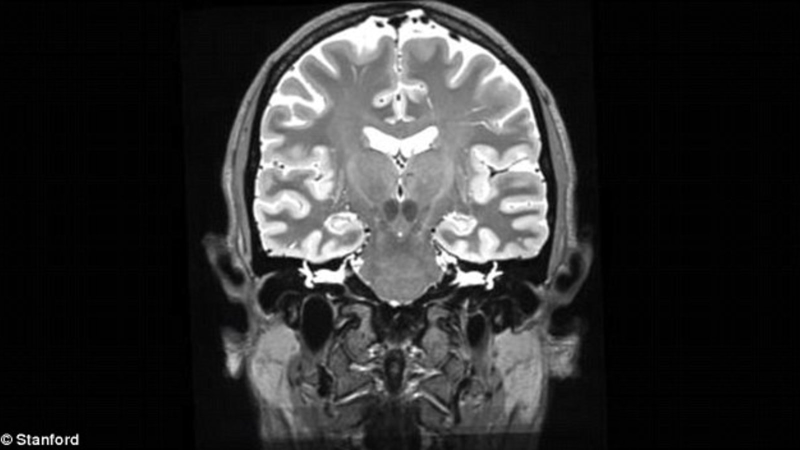 Image IRM d'un cerveau