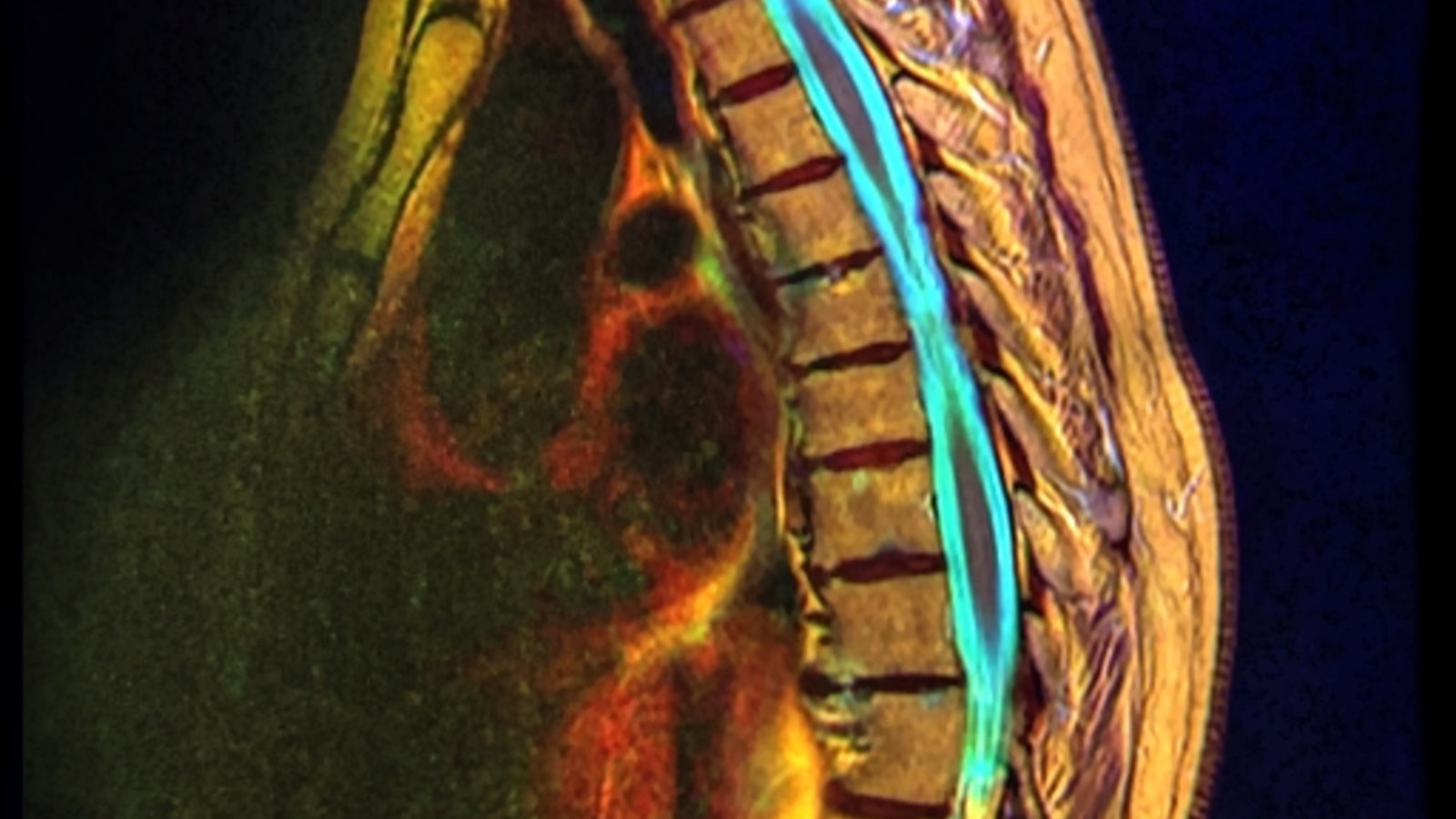 Dorsal vertebrae MRI