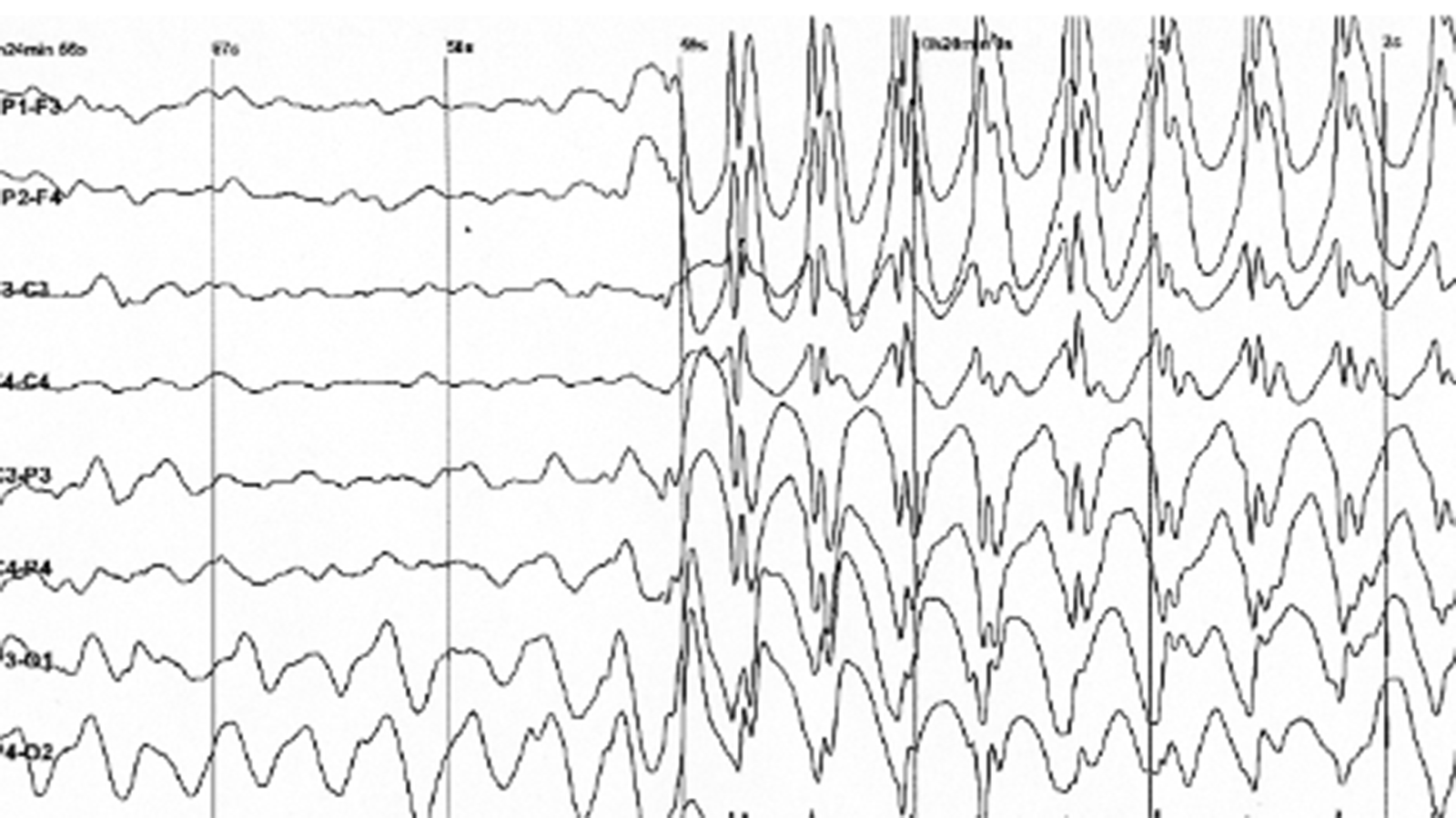 Électroencéphalogramme caractéristique d'une crise d'épilepsie.png