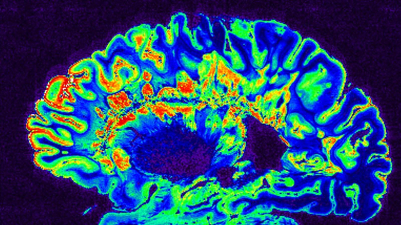 cerveau-scan.jpg