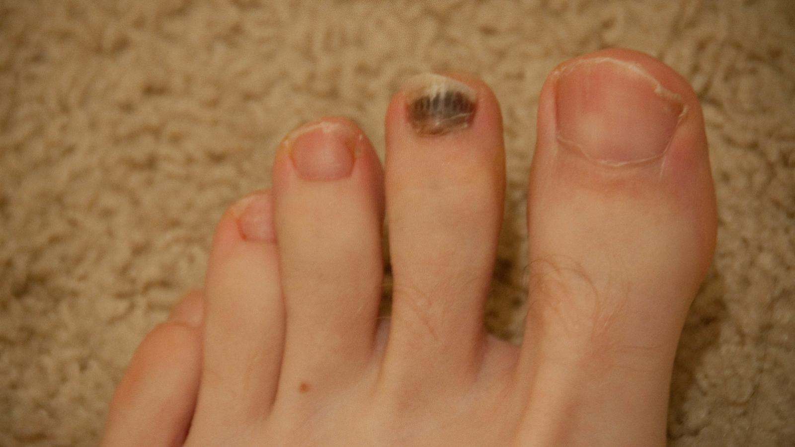ongle-orteil-noir.jpg