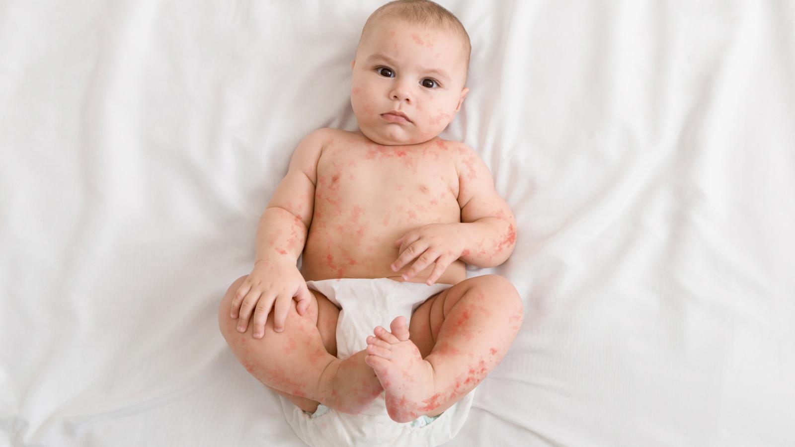 Bébé allongé sur le dos et présentant une rougeole