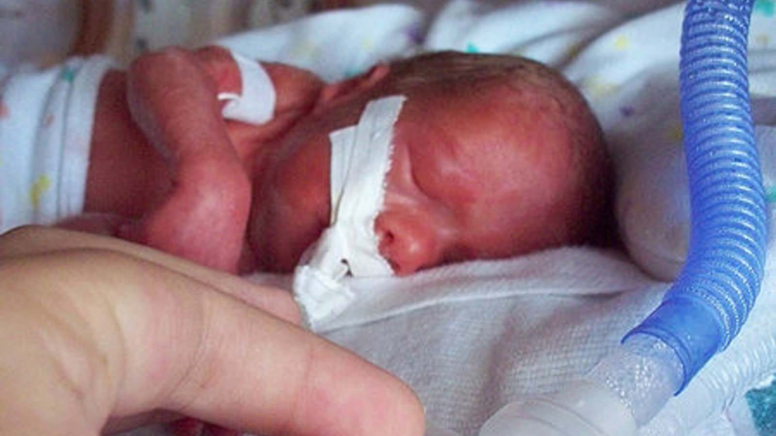 450px-premature_infant_with_ventilator.jpg