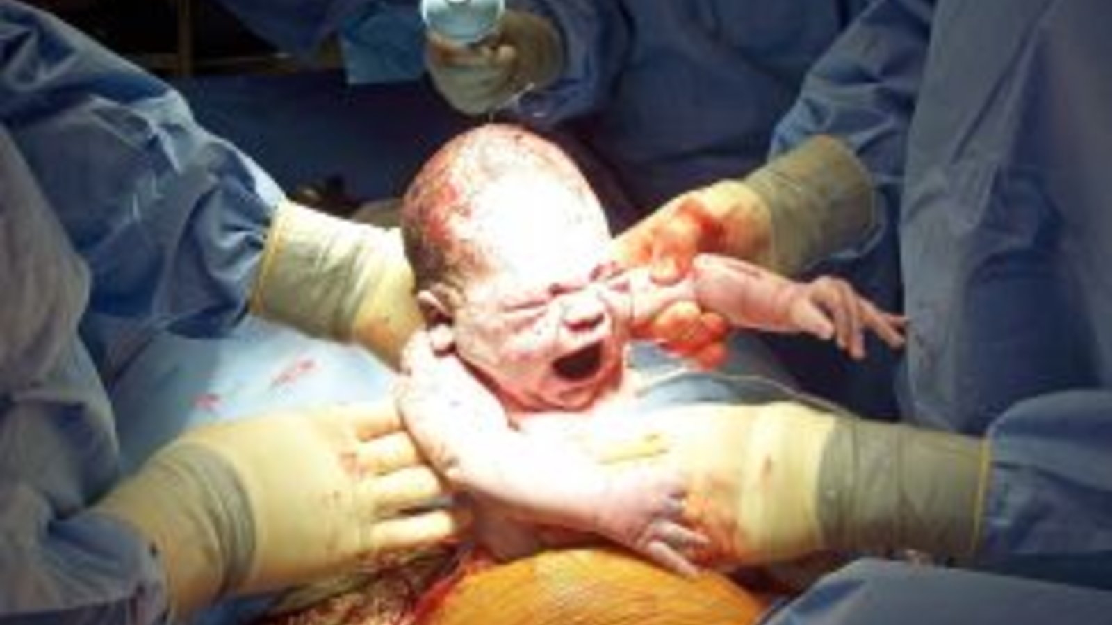 751051_caesarean_birth_1.jpg