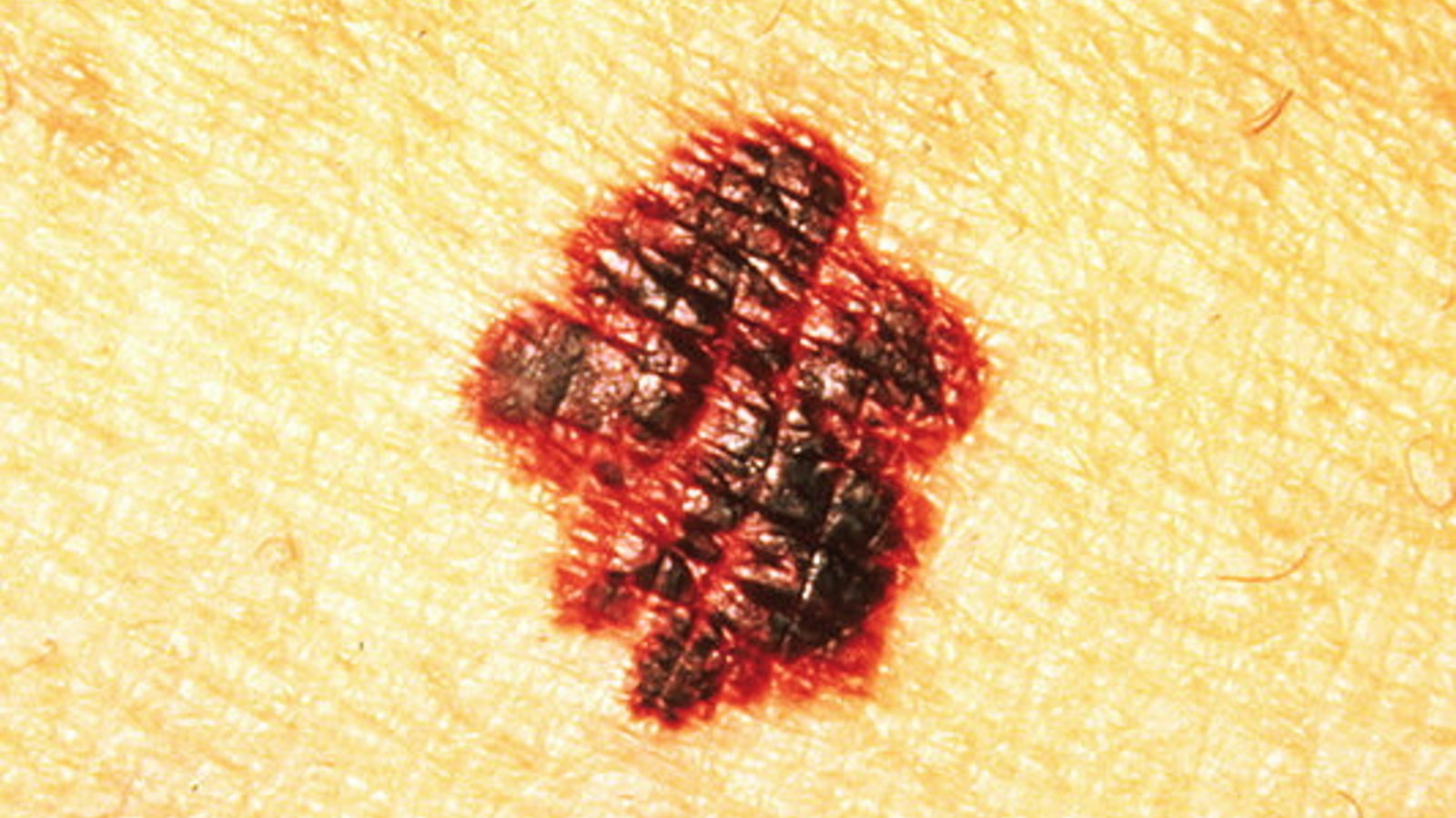 800px-melanoma_border.jpg