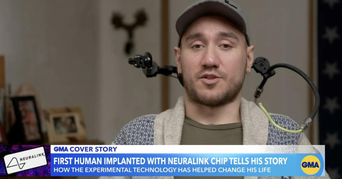 Brain implant: wires come loose