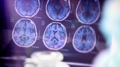 Imagerie du cerveau