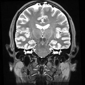 Image IRM d'un cerveau