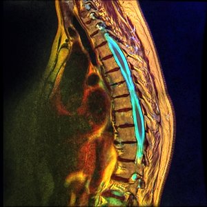 Dorsal vertebrae MRI
