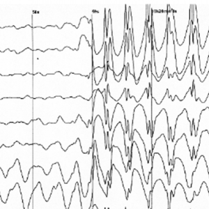 Électroencéphalogramme caractéristique d'une crise d'épilepsie.png