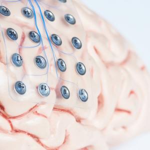implant-cerveau-Dreamstime.jpg