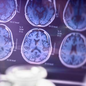 Imagerie du cerveau