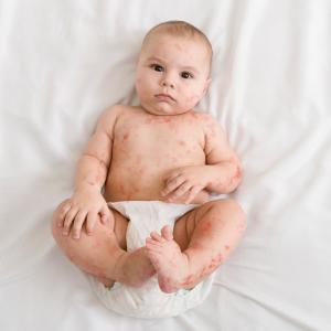 Bébé allongé sur le dos et présentant une rougeole