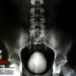 2007-cancer-prostate.png