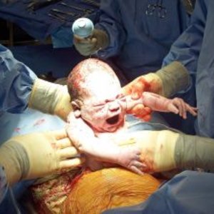 751051_caesarean_birth_1.jpg