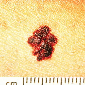 800px-melanoma_border.jpg