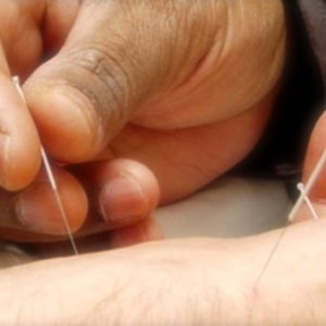 acupuncture.jpg