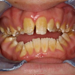 b_amelogenesis_imperfecta.jpg