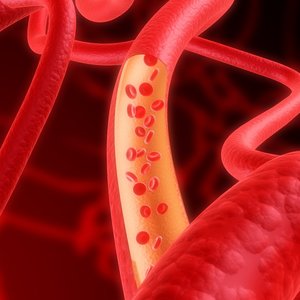 dt_artery.jpg