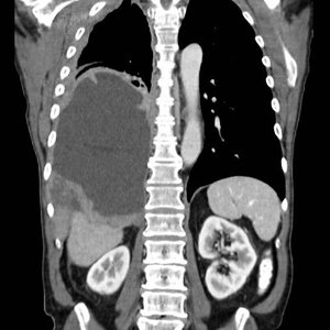 tumor_mesothelioma2.jpg